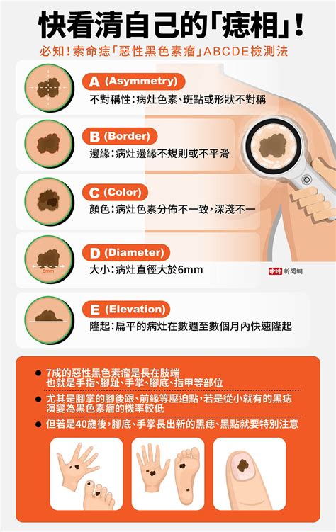 手長黑斑|今日最健康》快看看手掌和腳底 長出5種黑斑 恐是索命痣